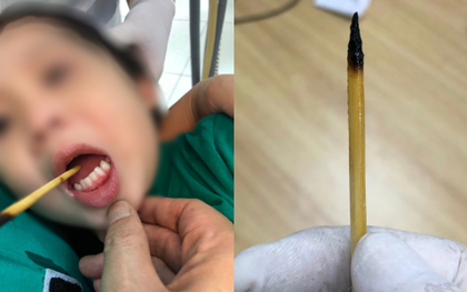 Ngã lúc chơi đùa, bé gái 3 tuổi bị que xiên thịt đâm xuyên lưỡi