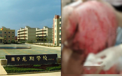 Nam sinh Trung Quốc nghi bị bạn dội nước sôi vào người: Cảnh sát tạm giữ 8 người