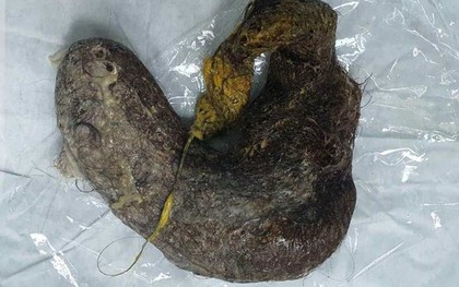 Lấy búi tóc nặng 700 gram trong bụng bé gái ‘nghiện ăn tóc’