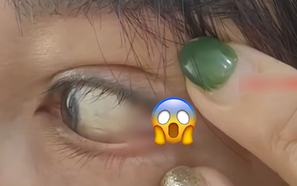 Bỏ 105 triệu cắt mắt 2 mí, người phụ nữ kinh hoàng phát hiện...