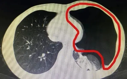 Chàng trai 25 tuổi bị thủng phổi, biết nguyên nhân, bác sĩ ngao ngán: Sao làm mạnh cỡ đó!?