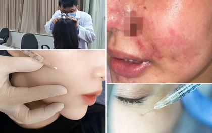 Bi hài chuyện "dao kéo" đổi vận: Chi tiền "khủng" tiêm gò má "vượng phu" suýt "mất mặt"