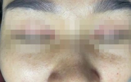 Hỏng da sau khi bôi loại kem được spa cam kết 'hết mụn sau 3 ngày'