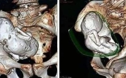 Chụp CT cho cụ bà 73 tuổi, bác sĩ sốc nặng khi phát hiện thai nhi hóa đá 30 năm