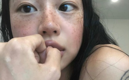 5 thay đổi trên khuôn mặt “vạch trần” những người thận yếu, ung thư thận dù ít ai để ý