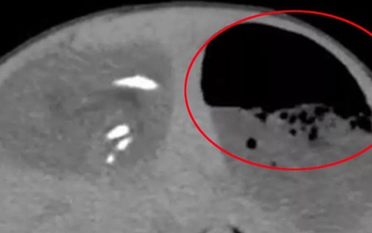 Bụng bé gái sưng to bất thường, bác sĩ phát hiện ra "bí mật" đáng sợ