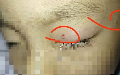 Cậu bé bị nhiễm trùng, mù một bên mắt vì hành động của giáo viên