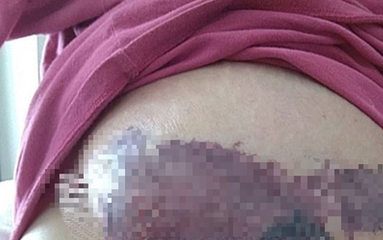 Người phụ nữ mới sinh ngực đột ngột chuyển màu đen, bác sĩ sốc nặng khi phát hiện "bí mật" đáng sợ