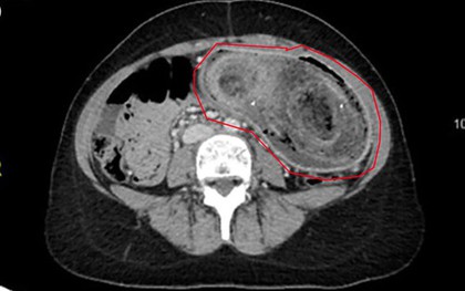 Thiếu nữ 17 tuổi liên tục đau bụng, nôn ói, bác sĩ sốc nặng khi phát hiện "bí mật" đáng sợ