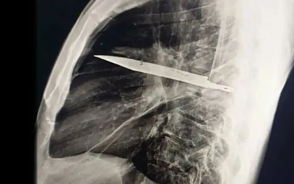 Người đàn ông mang "thứ này" trong lồng ngực suốt 8 năm mà không hề hay biết