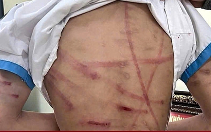 Bé gái lớp 5 ở Hà Tĩnh bị cha dượng bạo hành dã man: Đây không phải lần đầu