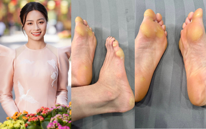 Bàn chân biến dạng của hot girl bóng đá Hoàng Thị Loan gây xôn xao