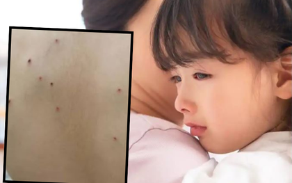 Tắm cho con gái, mẹ phát hiện những vết chấm li ti lạ trên lưng, biết nguyên nhân chị tuyên bố: Không thể nhẫn nhịn!