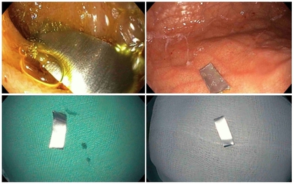 Bé 10 tháng suýt thủng ruột vì nuốt "lưỡi dao" trong điếu thuốc lá