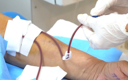 Nhiều người trẻ suy thận do biến chứng từ viêm cầu thận IgA