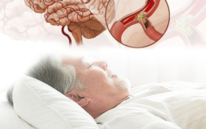 Cảnh báo nguy cơ đột tử do ngủ ngáy kéo dài