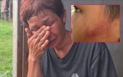 Bé trai 7 tuổi bị cô giáo dùng thước sắt đánh 14 lần vì ăn một viên kẹo