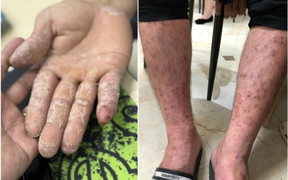 Những bệnh về da thường gặp sau mưa lũ