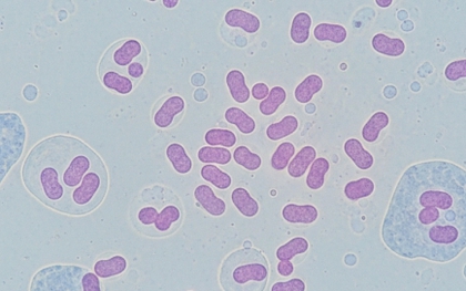 Hà Nội ghi nhận ca mắc não mô cầu là trẻ 11 tuổi, chưa tiêm vaccine