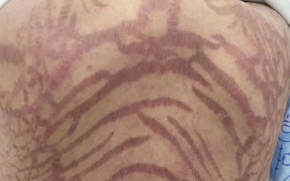 Da đầy vết rạn như da rắn vì thuốc mỡ bôi da mua trên mạng