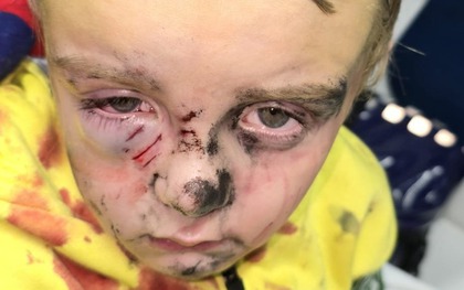 Bé trai 5 tuổi bị chó dữ tấn công khi đang đi dạo ở công viên