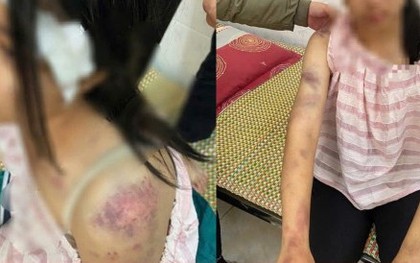 Bé gái bị người nhà đánh đập, tra tấn dã man vì nghi trộm tiền