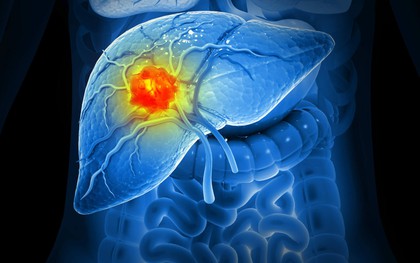 3 dấu hiệu sớm của ung thư gan nhưng dễ bị bỏ qua nhất