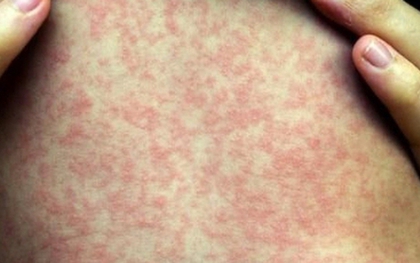 Dịch sởi bùng phát tại một xã