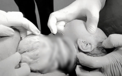Bé gái chào đời với 6 vòng dây rốn quấn cổ, mẹ tiền sản giật