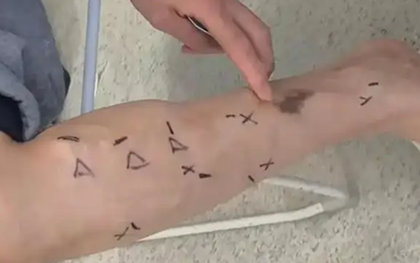 Đầu bếp 40 tuổi chân thâm đen gần như loét chỉ sau 1 năm vì thói quen nhiều người làm mỗi ngày