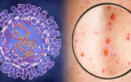 Xuất hiện ca bệnh đậu mùa khỉ chưa rõ nguồn lây ở Đồng Nai