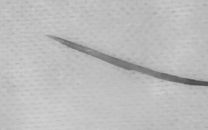 Người đàn ông 57 tuổi đau bụng thốc ngược lên, bác sĩ gắp ra thứ "đáng sợ" dài 5cm