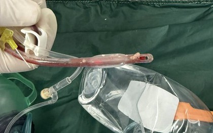 Bác sĩ cấp cứu đau lòng trước bé gái 3 tuổi sặc thức ăn ở nhà trẻ