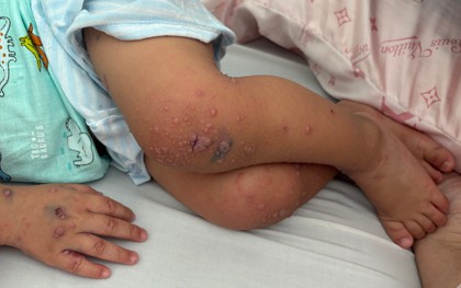 Nhiều trẻ mắc tay chân miệng trở nặng do tác nhân EV71, bác sĩ khuyến cáo gì?