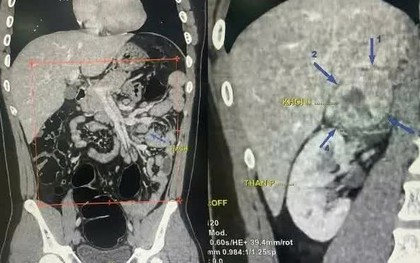 Tiểu hồng kéo dài, nam thanh niên 19 tuổi phát hiện u thượng thận 6 cm