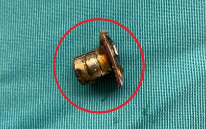 Bé 2 tuổi đang chơi bỗng ho tím tái, bác sĩ gắp ra thứ "đáng sợ" trong bụng