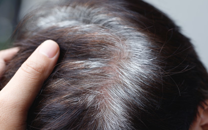 Bác sĩ nói gì về tin “tóc bạc nhiều là dấu hiệu ung thư”?