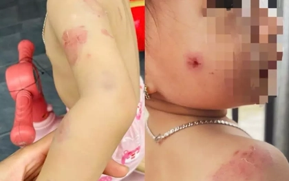 Phụ huynh bức xúc khi con gái hơn 2 tuổi chi chít vết cắn trên người sau giờ học