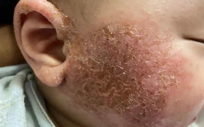 Cảnh báo các bệnh da liễu thường gặp khi thời tiết lạnh