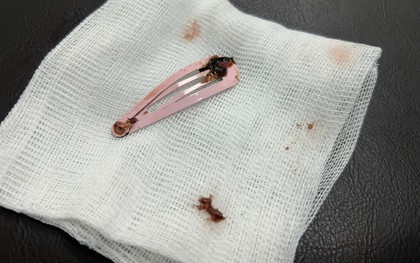 Gắp kẹp tóc dài 7cm khỏi dạ dày bé gái 6 tuổi