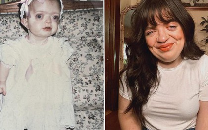 Tôi đã che giấu khuôn mặt suốt nhiều năm, nhưng giờ tôi tự hào chấp nhận vẻ khác biệt của chính mình