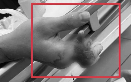 Cuộc mổ xuyên đêm cứu 4 ngón tay dập nát, gần đứt rời