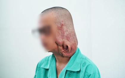 Phẫu thuật cắt bỏ khối u sợi thần kinh gần 1kg gây biến dạng mặt