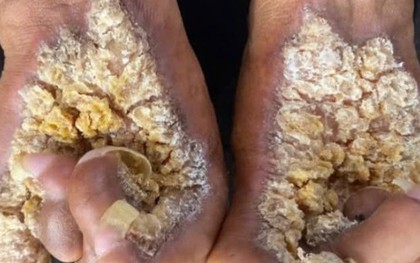 Người đàn ông thứ hai tại Việt Nam mắc hội chứng “người cây”