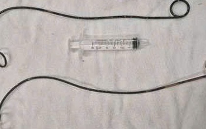 Bệnh nhân ở Cà Mau "bỏ quên" ống thông JJ trong người suốt hơn 10 năm