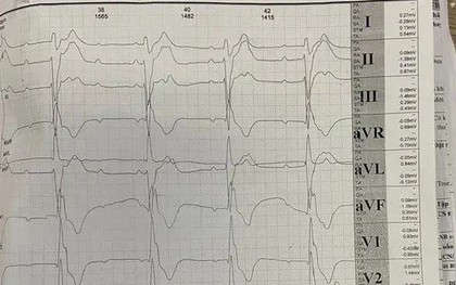 Hội chứng Kearns-Sayre - bệnh di truyền hiếm đe dọa tim mạch ở người trẻ