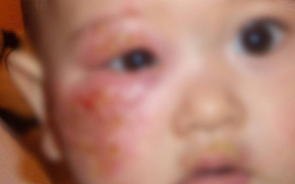 Bé gái 4 tuổi mắc giang mai - nguồn lây không ngờ từ một thói quen cho cháu ăn của bà nội