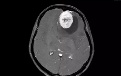 Người phụ nữ bị u màng não khổng lồ, bác sĩ chỉ ra những dấu hiệu dễ nhầm lẫn