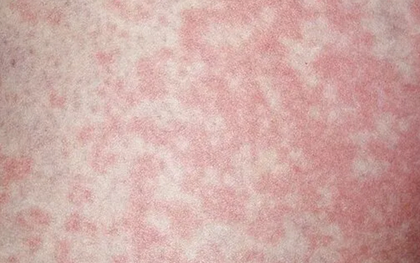 Người đàn ông nhiễm nấm vùng kín vì thói quen nhiều người làm với đồ lót của mình