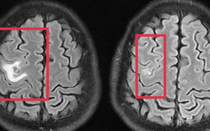 Co giật do sán não suýt nhầm lẫn với u não